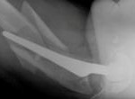 Fracture around a femoral component